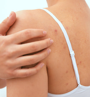  The Best Natural Body Acne Treatments