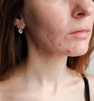  Hormonal vs. Bacterial Acne: Here's How to Tell Which Type You Have