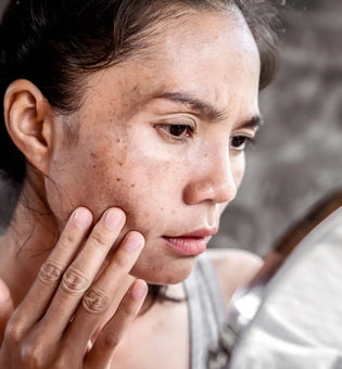 Hyperpigmentation 101: The Key Causes and Treatments
