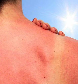  The Best Way to Treat Sunburn Naturally