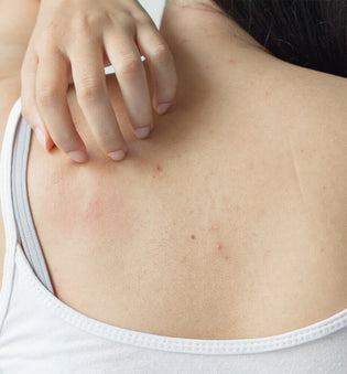  How to Get Rid of Back Acne