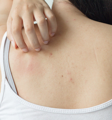 Blog Feed Article Feature Image Carousel: How to Get Rid of Back Acne 