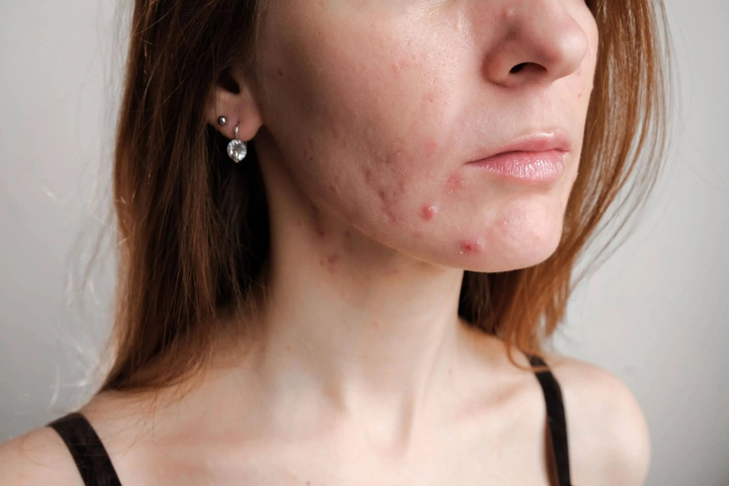 Hormonal vs. Bacterial Acne: Here's How to Tell Which Type You Have